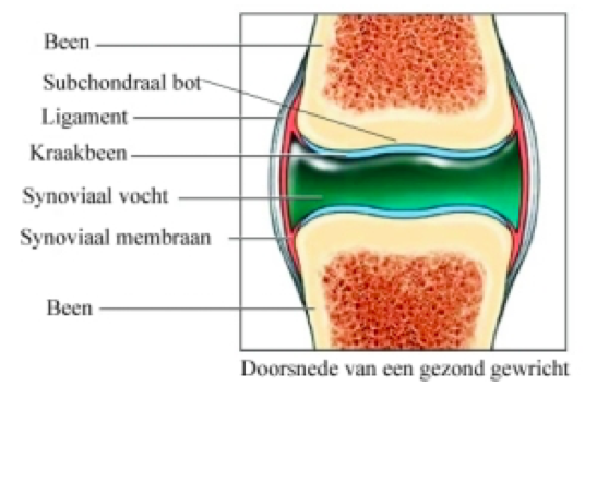 Waarom artrose echt een vorm van reuma is. 